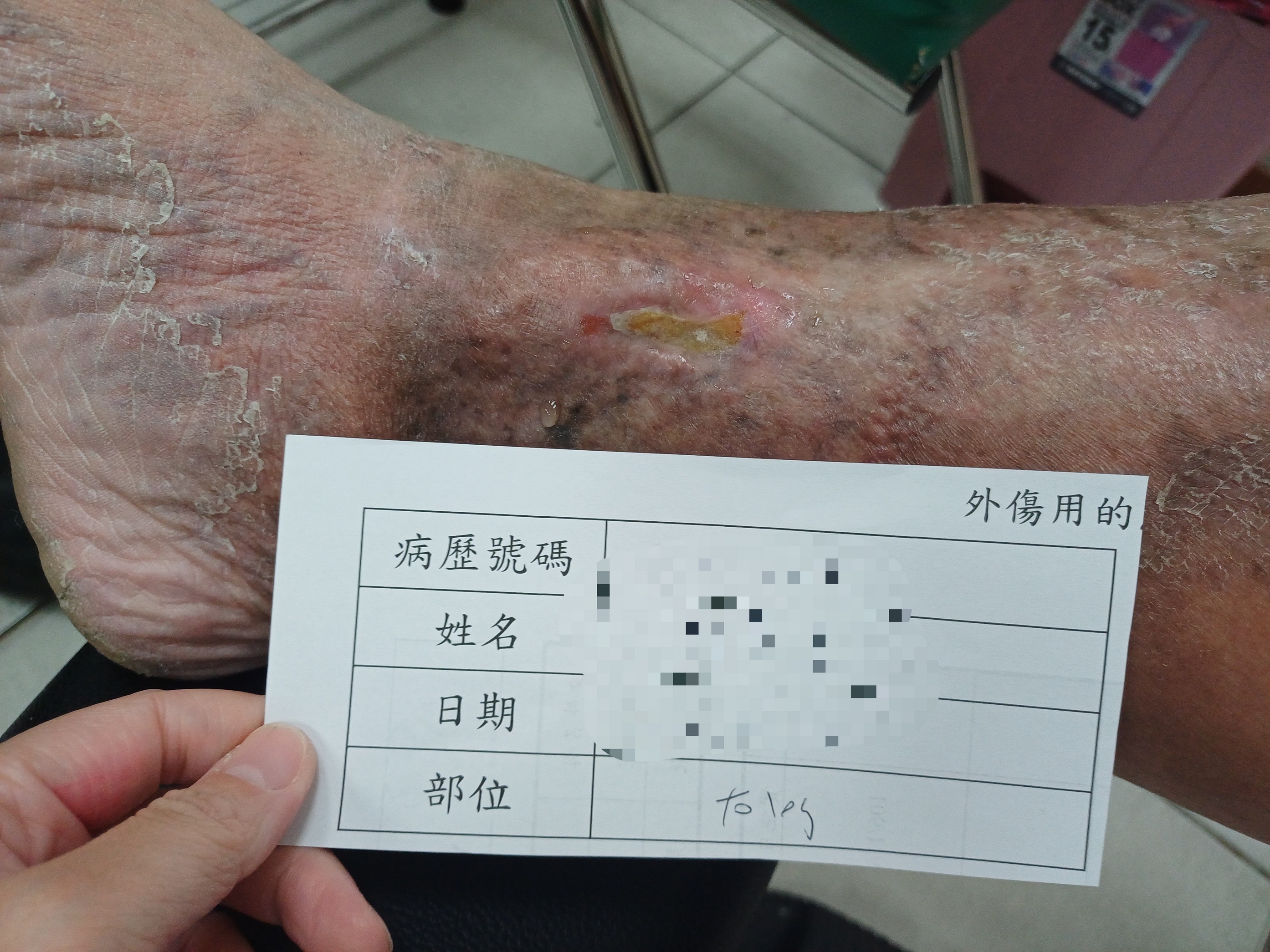 十年潰爛終癒合!員榮微創鐳射手術擺脫「靜脈曲張潰瘍」困擾 - https://www.watchmedia01.com