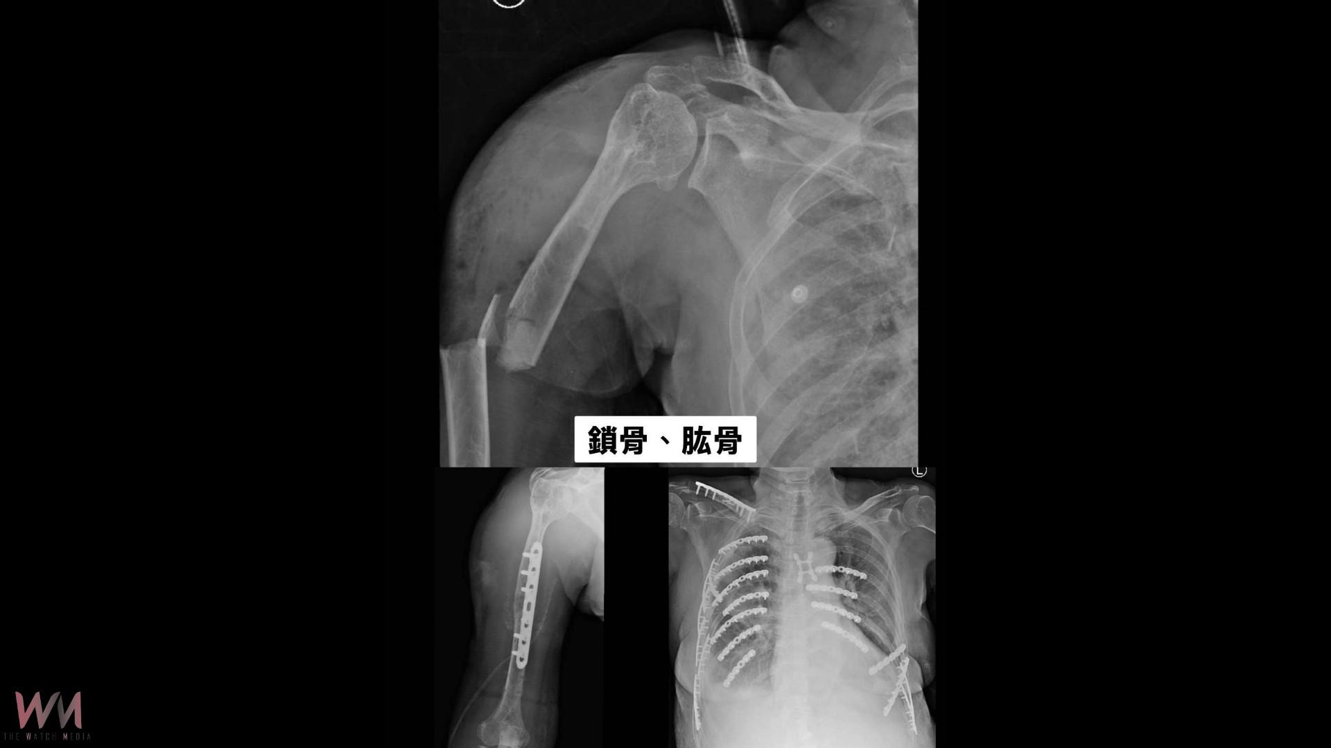 （有影片）／「奇蹟病人」70歲婦車禍骨碎如拼圖　7次手術奇蹟救回一命 - https://www.watchmedia01.com