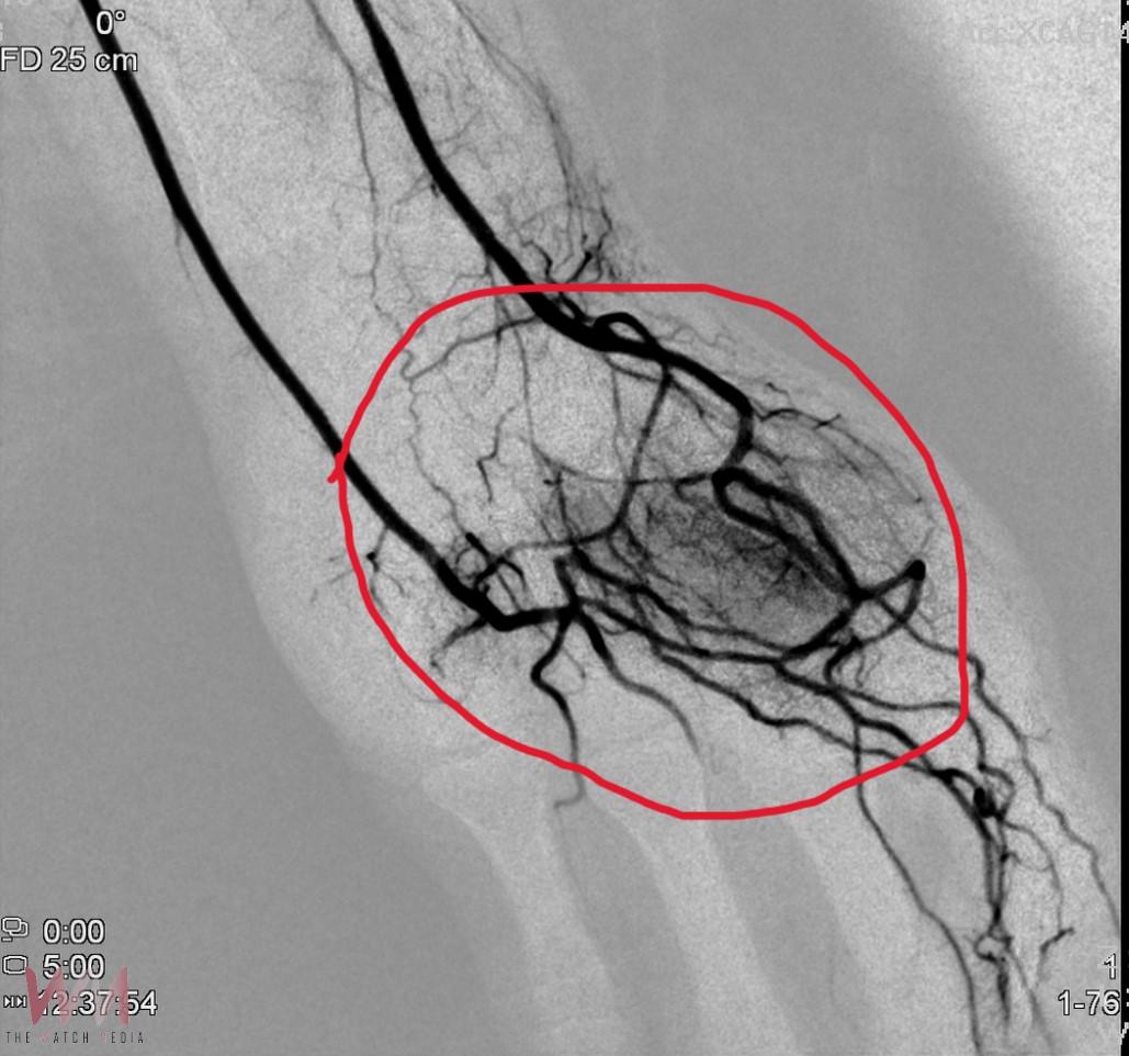 （有影片）／痛半年無法好眠　微導管栓塞術助男子終於「不再痛醒」 - https://www.watchmedia01.com