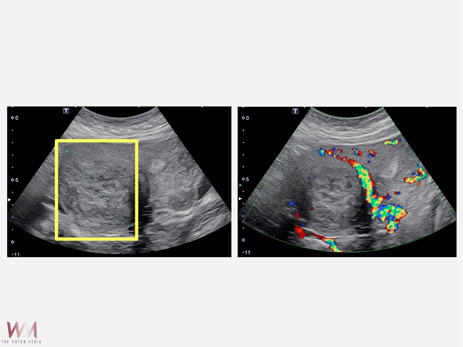 達文西機械手臂結合經陰道自然孔 打造「零腹部傷口」手術 - https://www.watchmedia01.com
