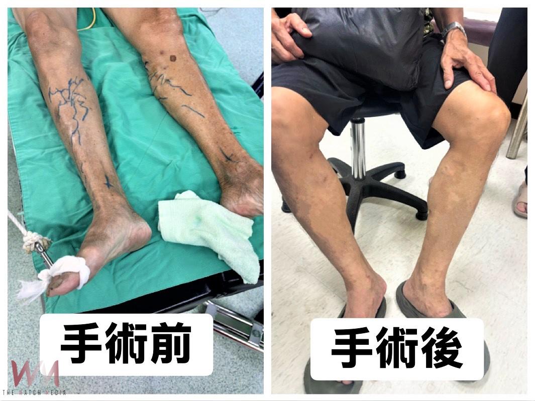 久站易患靜脈曲張　雷射手術治療無明顯傷口及疼痛感 - https://www.watchmedia01.com