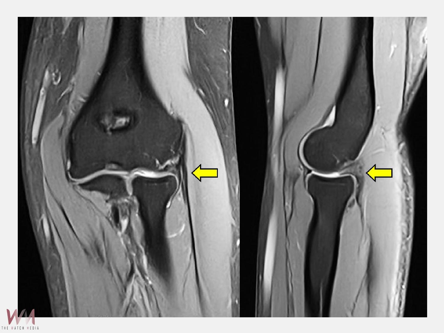 手肘外側疼痛不只是「網球肘」　微創關節鏡手術助女會計師恢復生活日常 - https://www.watchmedia01.com