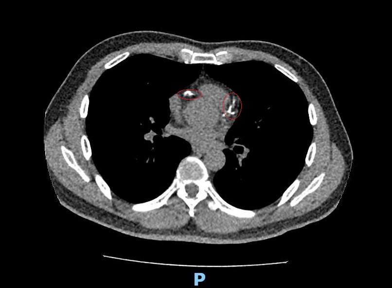 (有影片)/心血管鈣化也能震碎!彰化醫院首例 IVL 成功救回高危病患 - https://www.watchmedia01.com