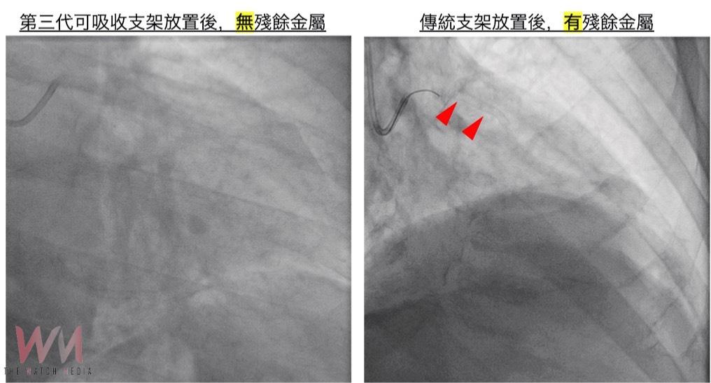 解除頑固型高血壓心臟未爆彈　立體定位神經消融術結合可吸收支架 保留血管彈性 - https://www.watchmedia01.com