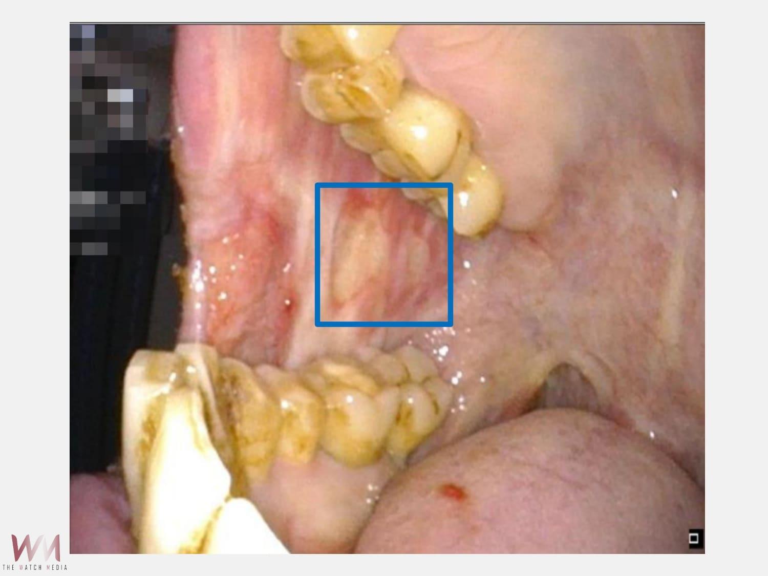 口腔癌切除腫瘤影響外觀 仁愛長庚顯微重建助找回自信與自理能力 - https://www.watchmedia01.com
