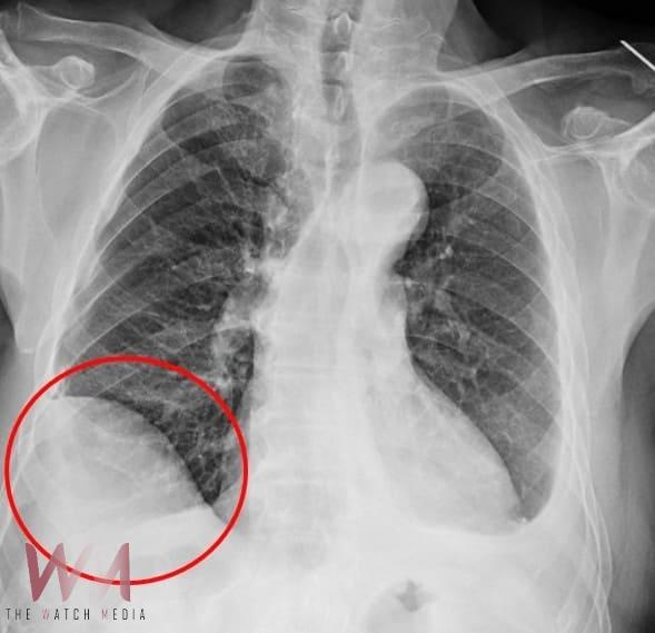 7旬罹癌男驚見肺腫瘤手術高難度 達文西助攻切除肺節 - https://www.watchmedia01.com