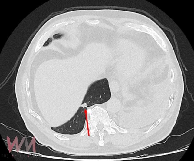 7旬罹癌男驚見肺腫瘤手術高難度 達文西助攻切除肺節 - https://www.watchmedia01.com