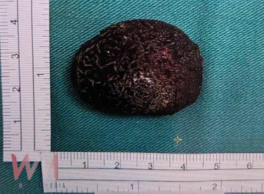 驚！男腰痠血尿就醫 右輸尿與左腎赫見大結石　緊急取石手術、震波碎石治療 - https://www.watchmedia01.com