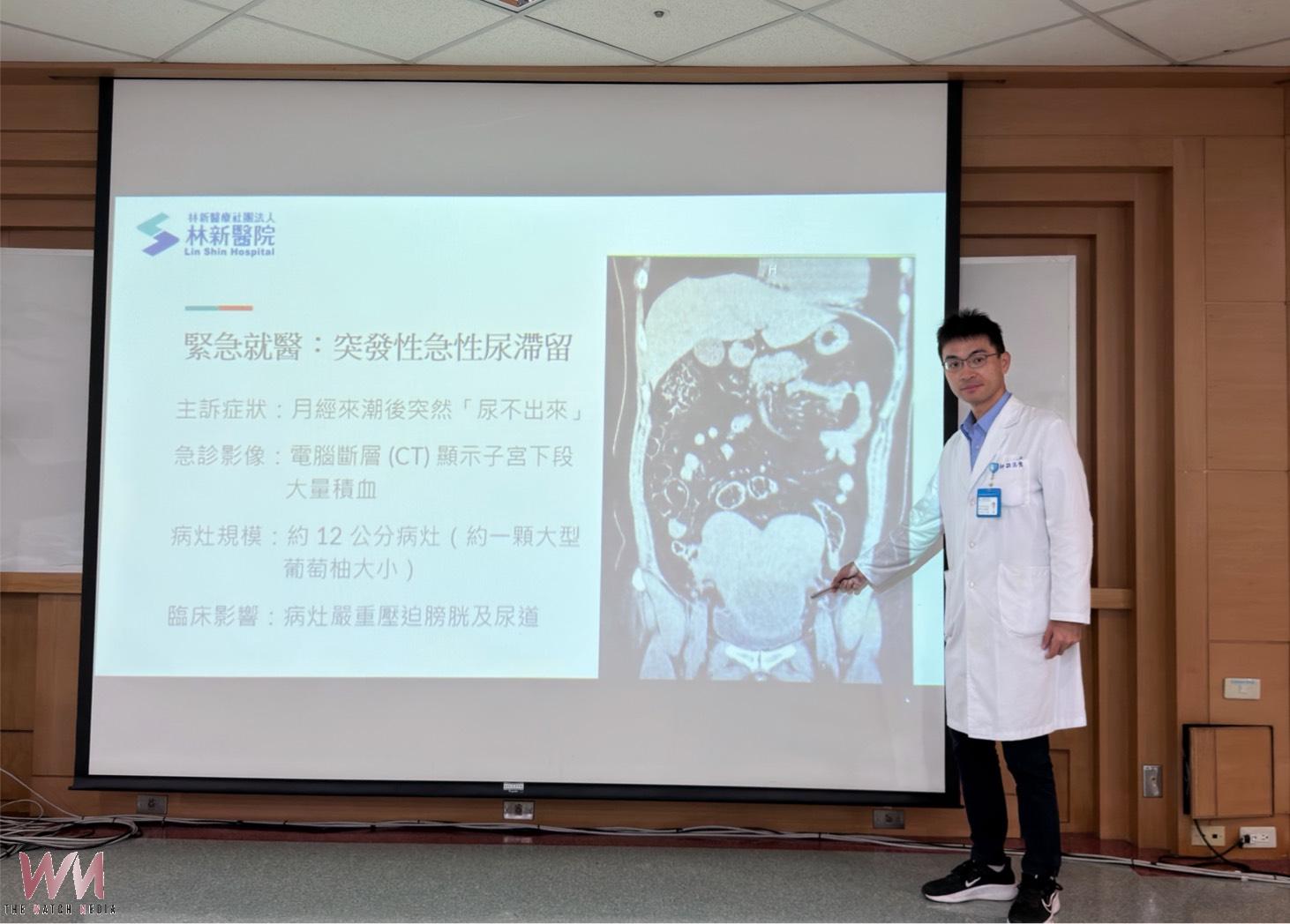 大量陳舊經血滯留壓迫膀胱　達文西手術解決雙子宮複雜構造 - https://www.watchmedia01.com