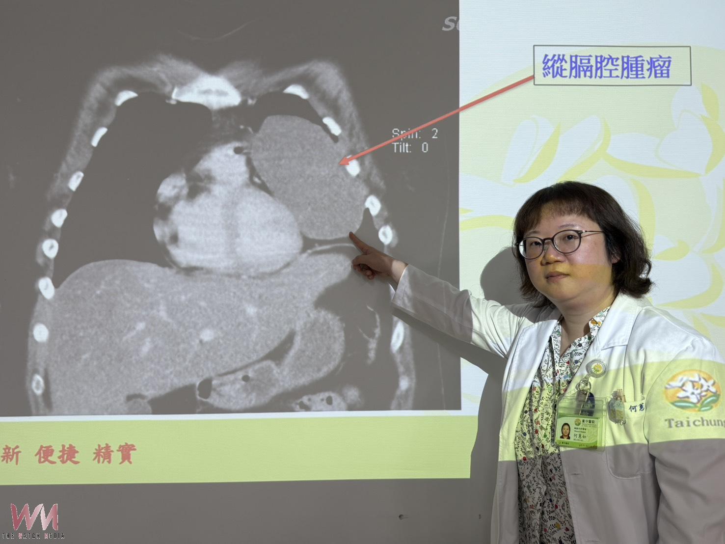 求職健檢驚見15公分腫瘤 24歲女接受胸腔鏡手術切除畸胎瘤 - https://www.watchmedia01.com