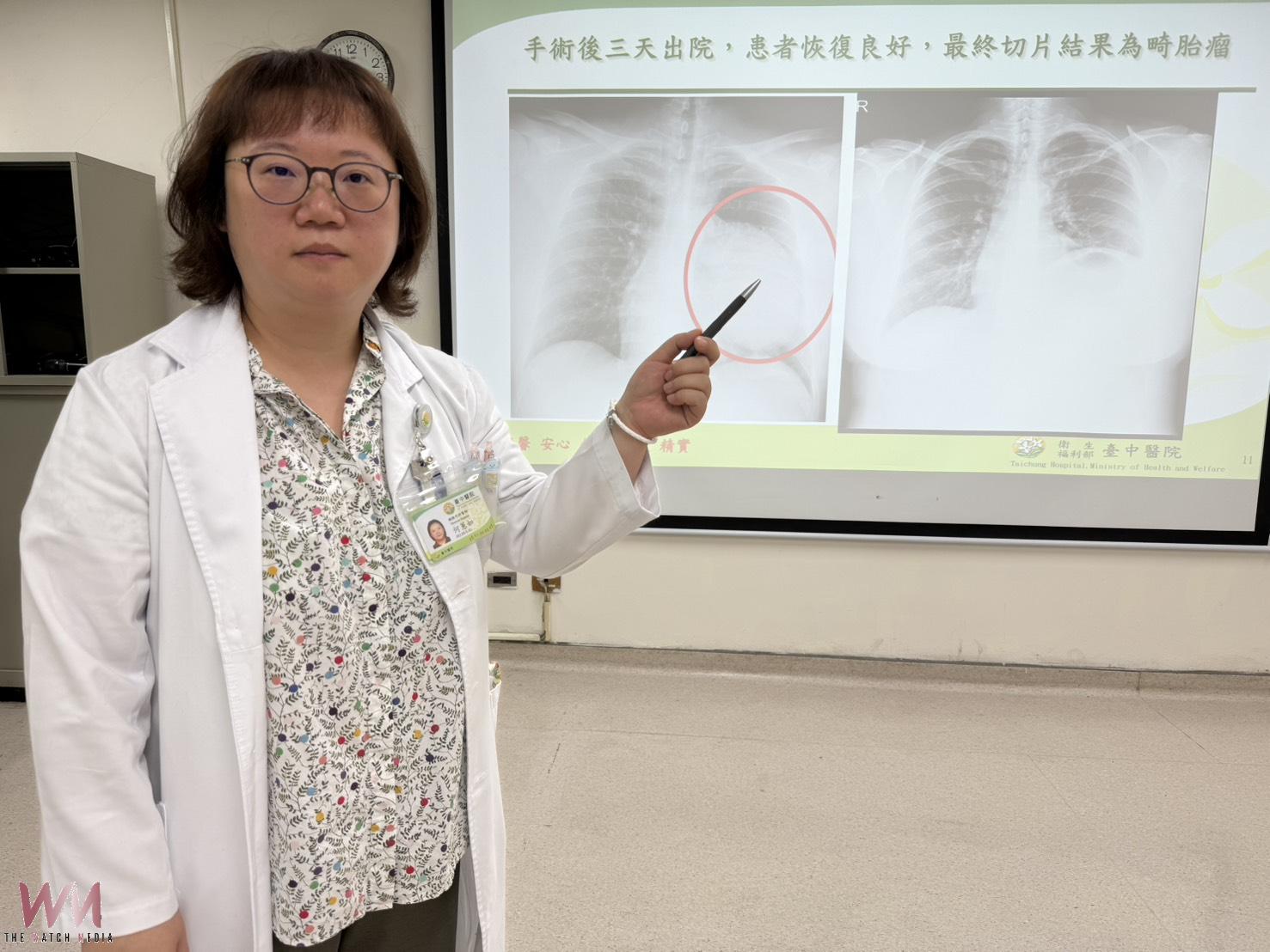 求職健檢驚見15公分腫瘤 24歲女接受胸腔鏡手術切除畸胎瘤 - https://www.watchmedia01.com
