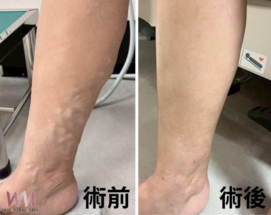 浮腳筋不痛不代表沒事　婦人忍30年突腫痛 醫：血栓風險恐增5.3倍 - https://www.watchmedia01.com
