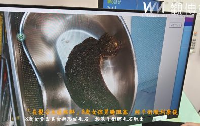 醫療團隊發現小安的胃部與小腸內竟充滿了毛髮結石，導致部分腸道阻塞。經過小兒外科醫師手術，成功將這些毛石取出。（彰基提供）