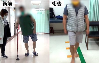 彰基成功為帕金森病患施行清醒式「深部腦刺激手術」，顯著改善顫抖與僵硬，恢復自主行動與生活品質。（彰化基督教醫院提供）
