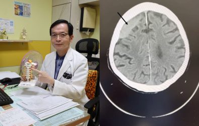 一名87歲陳姓老翁因頭暈跌倒，送醫急救檢查出顱內有血腫，醫師檢查發現患者腦部有一處舊傷，才引發癲癇造成跌倒。（員榮醫院提供）